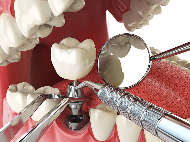 Best Emergency Root Canal Treatment in Guntersville, AL